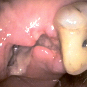 Zhermack Гидрогум - замешивание